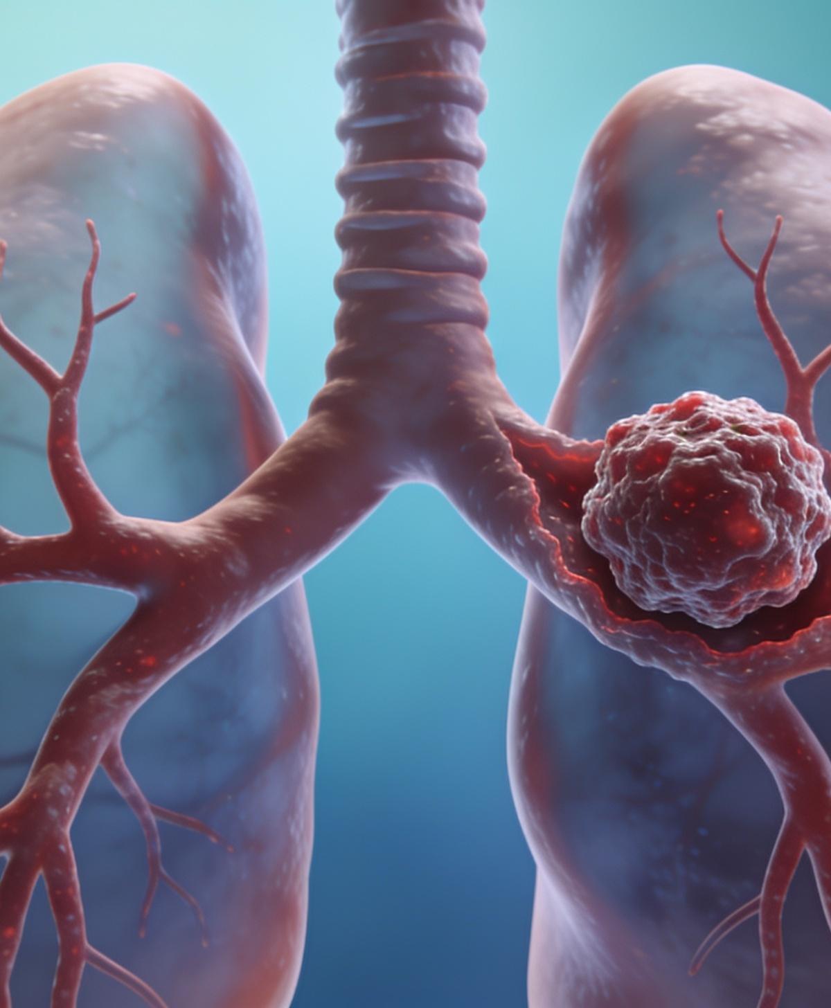 Tromboembolismo Pulmonar Agudo (TEP): o que todo médico deve saber pela diretriz AHA/ACC 2026