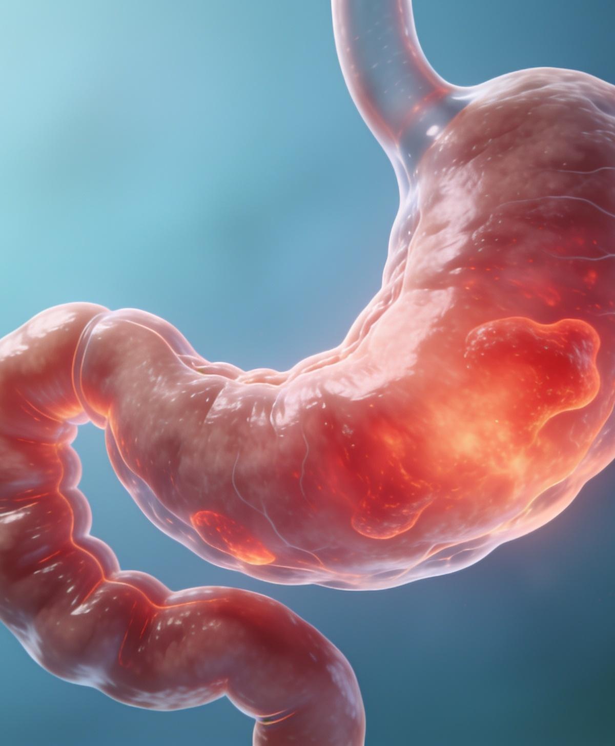 Doença de Crohn: diagnóstico, estratificação e tratamento segundo a diretriz ACG 2025